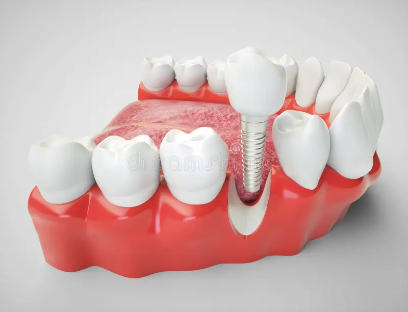 Dental implant technology 3D model of tooth implant embedded in gum and bone